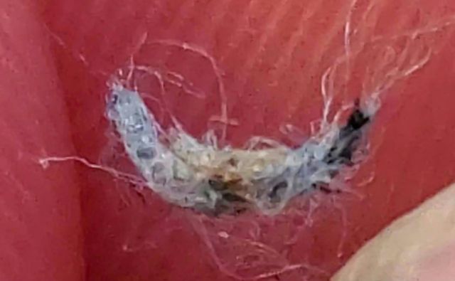  Morgellons Disease a misunderstood physical illness?