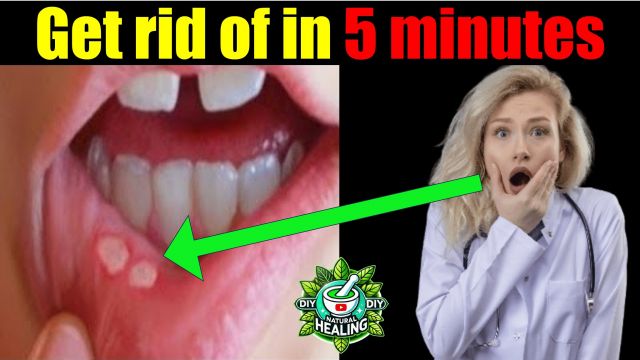 Get rid of mouth sores in 5 minutes #diy