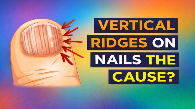 The Real Causes of Vertical Ridges on Your Nails